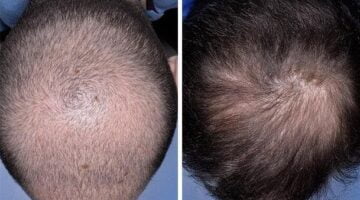 أفضل بخاخ لتساقط الشعر الوراثي بدون أي آثار جانبية 