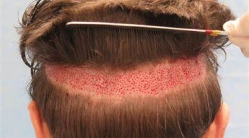 أضرار زراعة الشعر على المدى البعيد وأهم مخاطرها