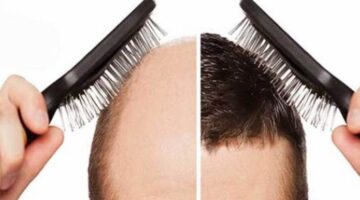استخدام المشط بعد زراعة الشعر.. مدة السماح وأسباب المنع
