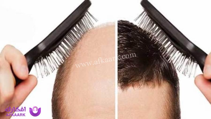 استخدام المشط بعد زراعة الشعر.. مدة السماح وأسباب المنع 9 استخدام المشط بعد زراعة الشعر