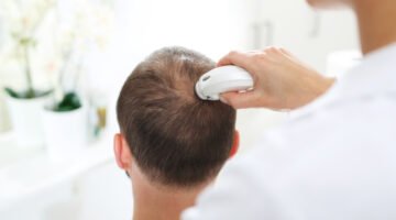 تحاليل تساقط الشعر للرجال | وتشخيص الصلع الوراثي