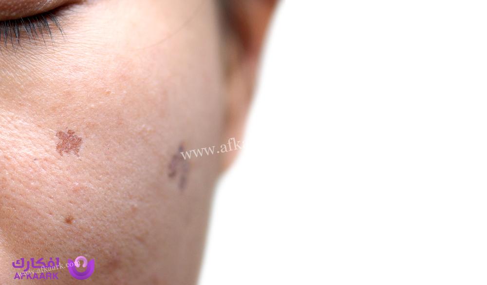 متى تختفي النقاط السوداء بعد الفراكشنال .. المدة الطبيعة المراحل التابعة للعملية 4 متى تختفي النقاط السوداء بعد الفراكشنال .. المدة الطبيعة المراحل التابعة للعملية