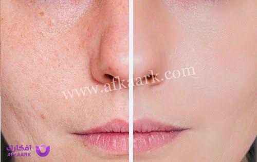 ظهور حبوب بعد الفراكشنال ليزر وأفضل الكريمات المستخدمة للتخلص منها 6 ظهور حبوب بعد الفراكشنال ليزر